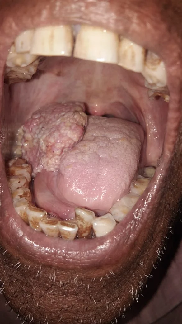 Cancer Patients