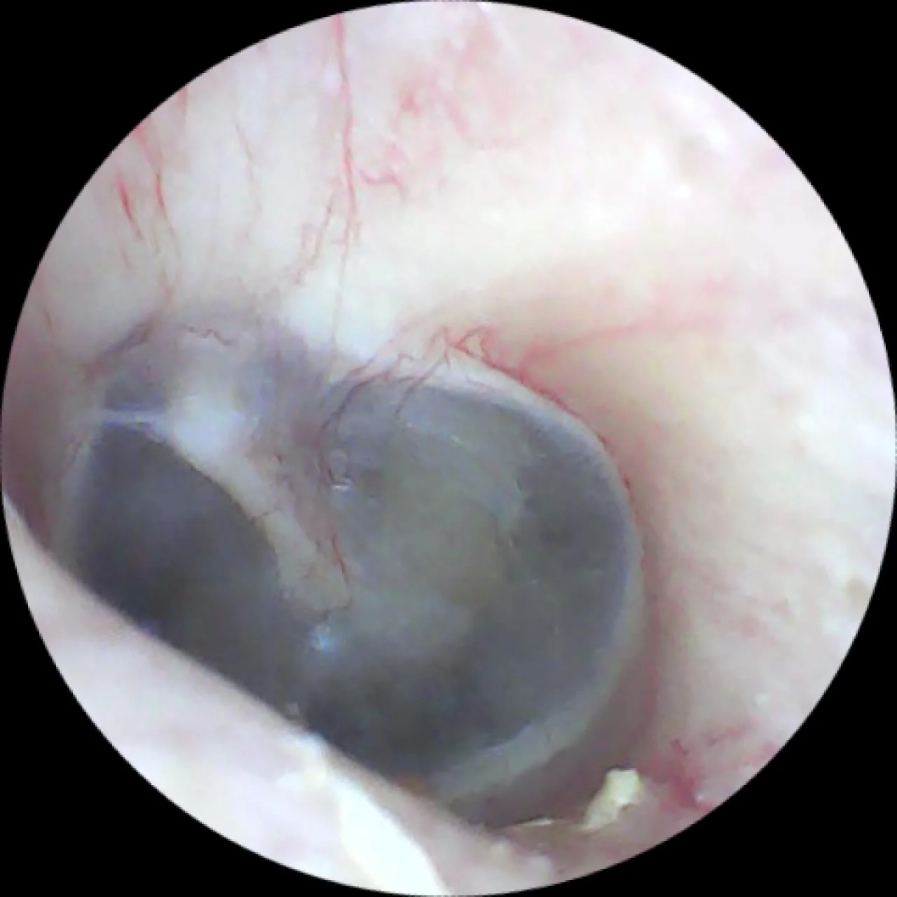 Ear Endoscopy