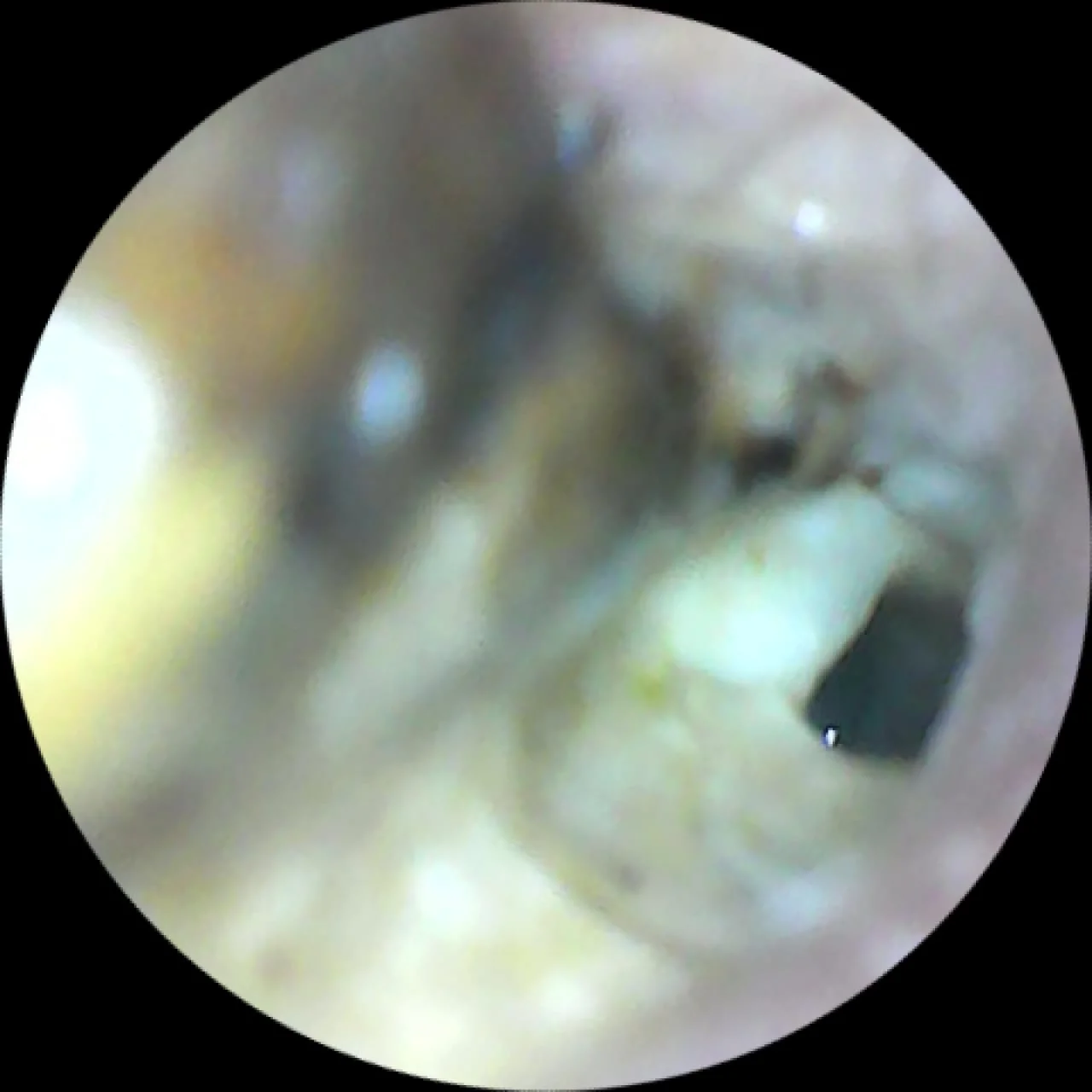 Ear Endoscopy