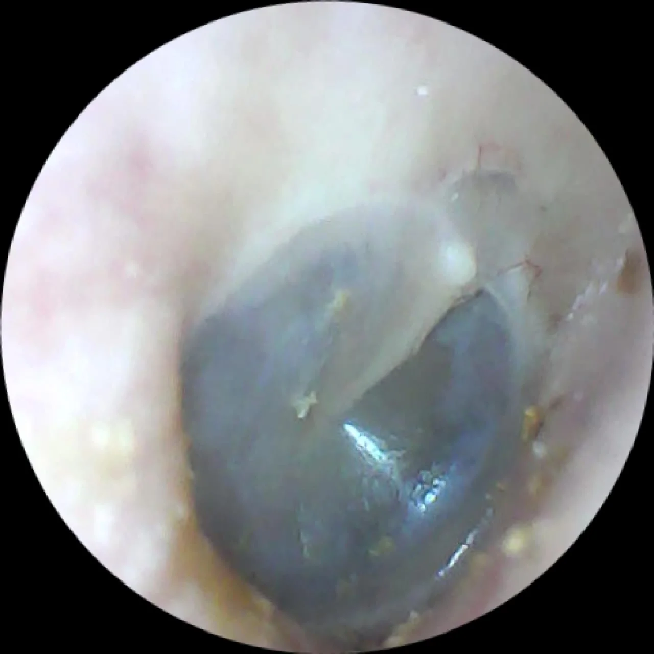 Ear Endoscopy