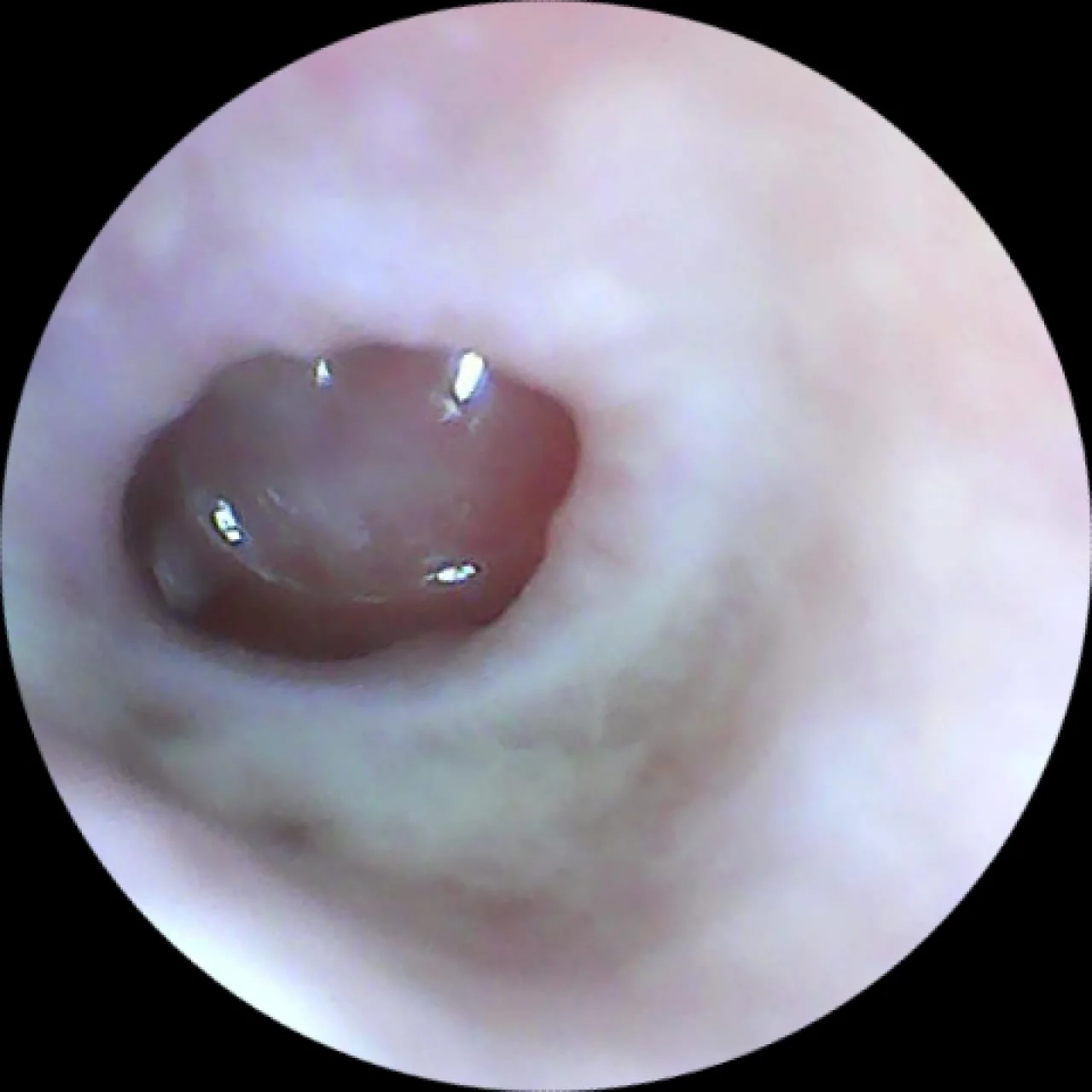 Ear Endoscopy