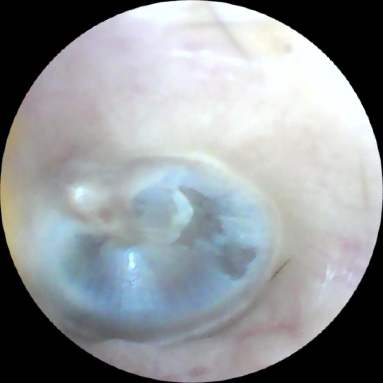 Ear Endoscopy