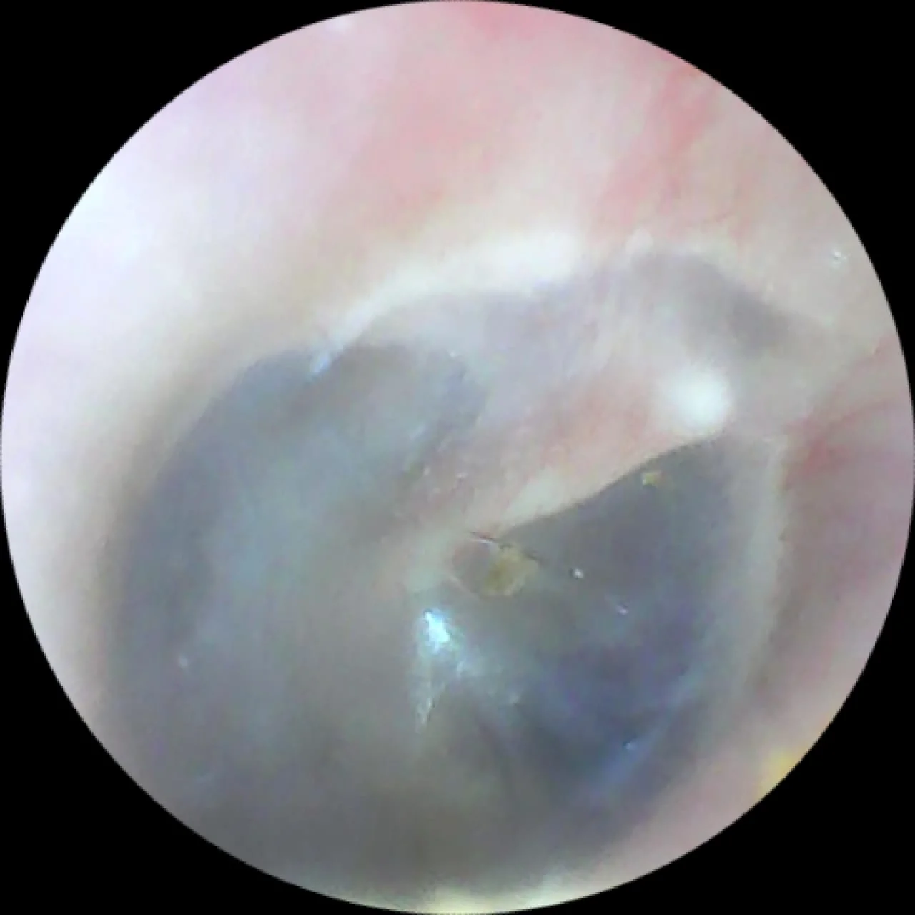 Ear Endoscopy