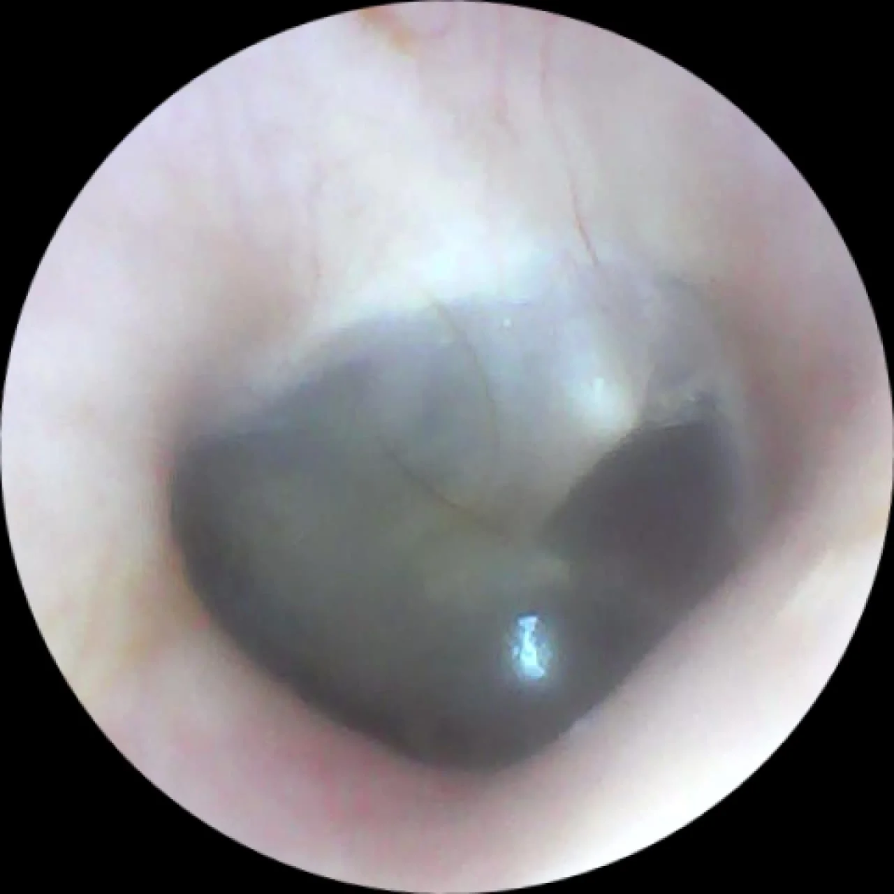 Ear Endoscopy