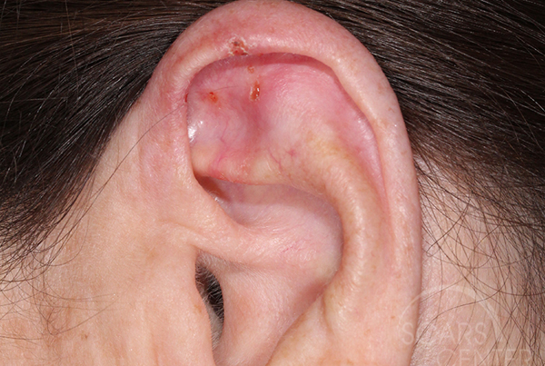 Ear Cancer