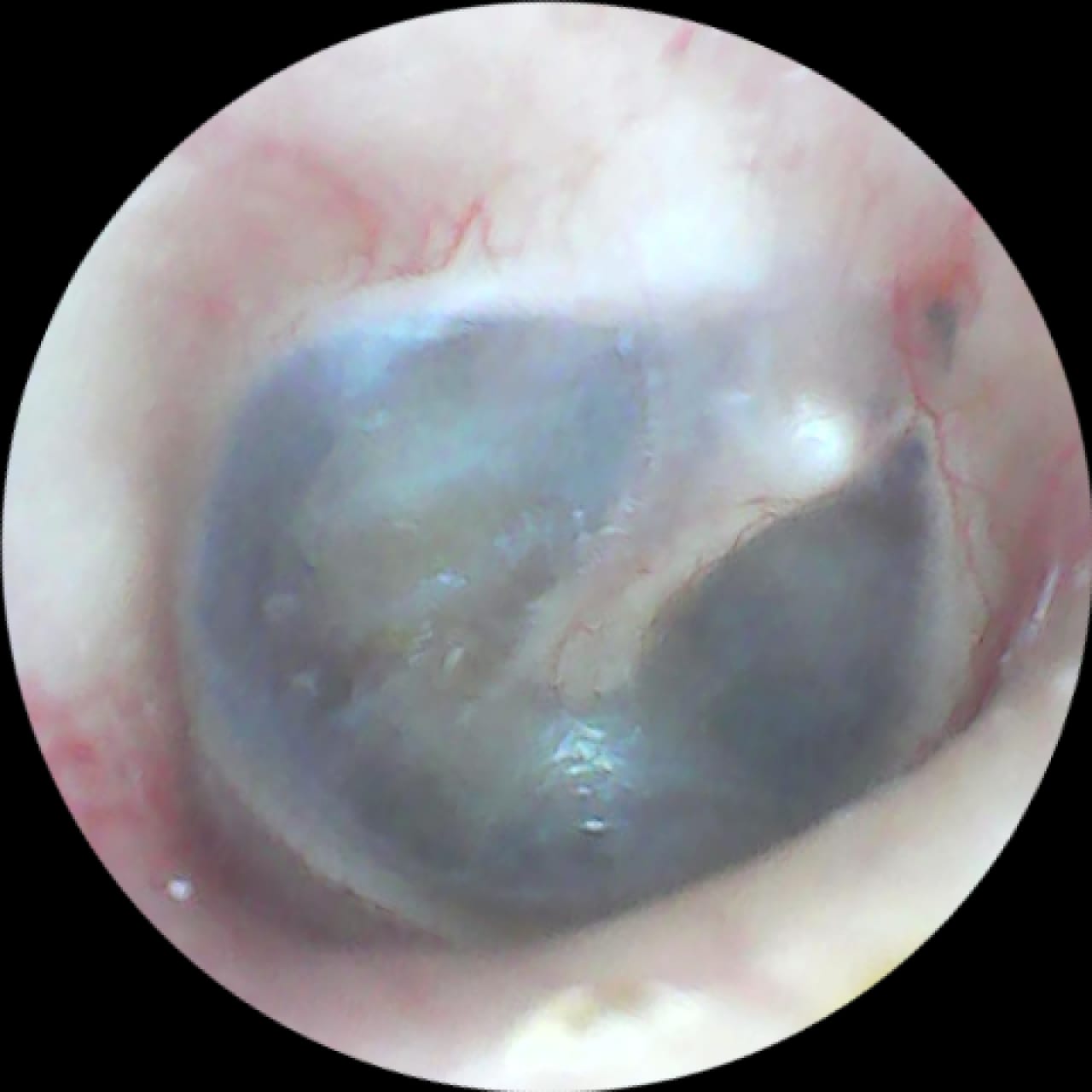 Ear Endoscopy