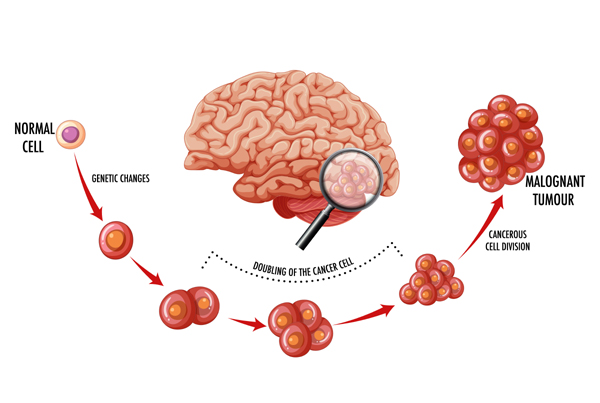 Skull Base Tumors