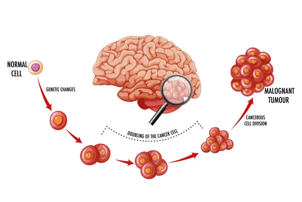 Skull Base Tumors